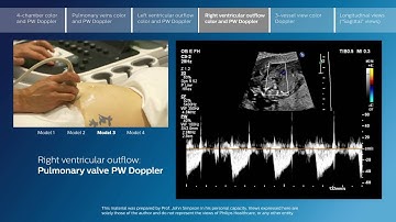 Part 4 - Right ventricular outflow color and PW Doppler