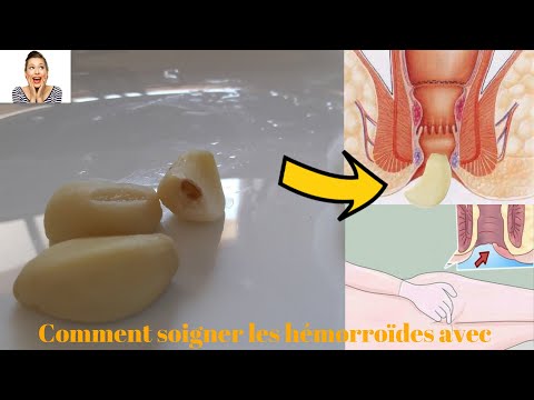 Vidéo: Saignement De L'anus - Causes, Suppositoires, Traitement