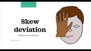 Skew deviation test / Test of Skew [Essential medicine]