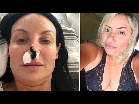 When Nose Jobs Go Wrong