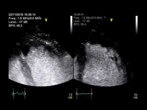 Apikaler LV Thrombus vor und nach Antikoagulation - YouTube