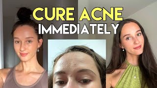 How to get RID of ACNE forever | my story by Lauren Courtney 103 views 3 months ago 10 minutes, 22 seconds