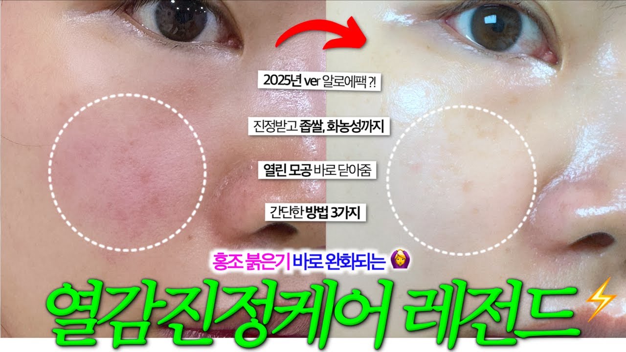 피부 예민+화끈+붉어짐? 여름 3대 고통, 이걸로 잡음🙆‍♀️ 간단한 열감진정케어 3가지 방법