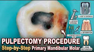 Pulpectomy Step-by-Step | Access Opening, Chemomechanical Prep & Obturation