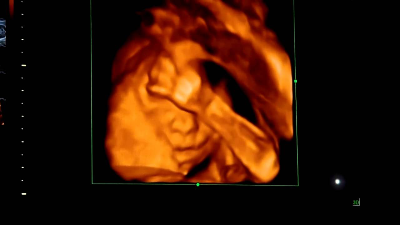 Échographie 3D du Deuxième Trimestre : Tout ce que Vous Devez Savoir