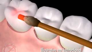 Minimally Invasive Laser Gum Surgery Alternative