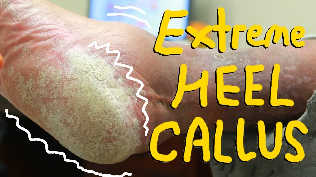 Extreme heel Psoriasis removal MY FIRST MISTAKE!! YouTube