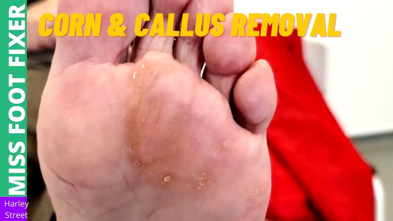 Corn & Callus Removal | Miss Foot Fixer - YouTube