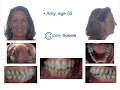 Dental Treatment: Accelerated Orthodontics Jul 17, 2018