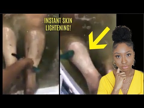 INSTANT Skin Bleaching Peel for Dark Skin!? Why I bleached my skin... 