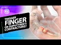 Trigger Finger vs. Dupuytren’s Contracture: What’s the Difference? (3D Animation)