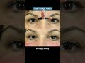 Tear Trough Fillers