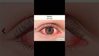 Types Of Eye Disease 🤯#eyes #optometrist #eyecareprofessional #eyespecialist #eyediseases
