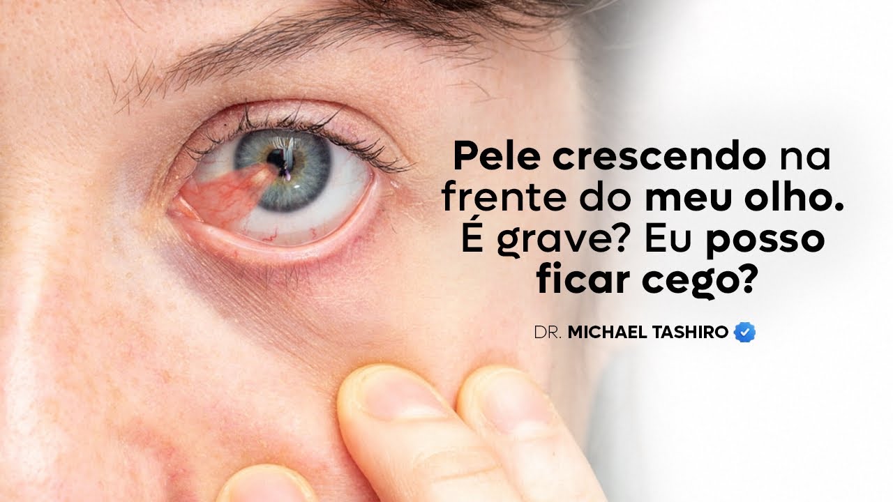 PTERÍGIO. Você já ouviu falar nessa pele que pode crescer na frente do ...