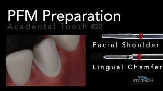 PFM Preparation on Mandibular Canine  Acadental Tooth #22