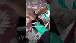 حجامه علاج ورم و اوجاع  القدم