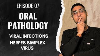 Dental Digest Oral Pathology Episode 7 - Herpes Simplex Virus