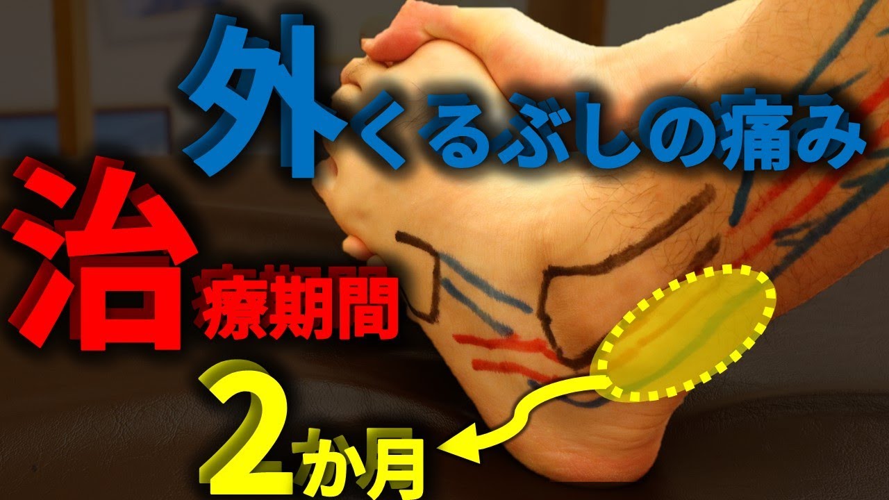 外くるぶしが痛くなる『腓骨筋腱炎』の治療期間は2か月！4つの検査方法で特定を！【腓骨筋腱炎＃2】