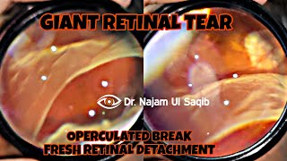 Giant Retinal Tear(GRT) And Operculated Break In A Fresh Retinal Detachment