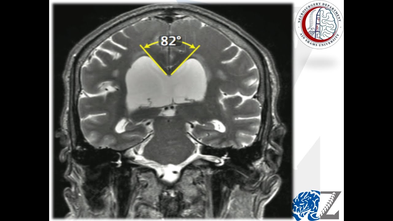 Hydrocephalus (4)  Normal Pressure Hydrocephalus  استسقاء الضغط الطبيعي بالمخ