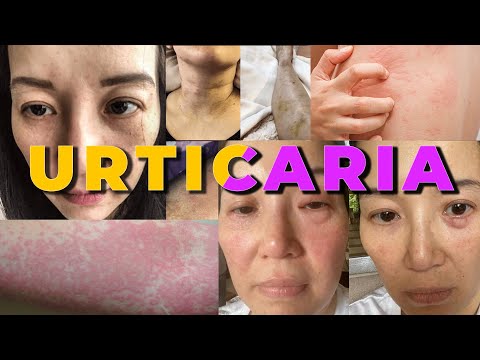 Urticaria | Kris Aquino&rsquo;s RARE Autoimmune Disease |The Worlds Burden 2022