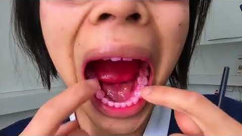 Using Disclosing Tablets