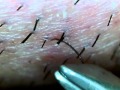 Tweezers! マイクロスコープ使っての毛抜き