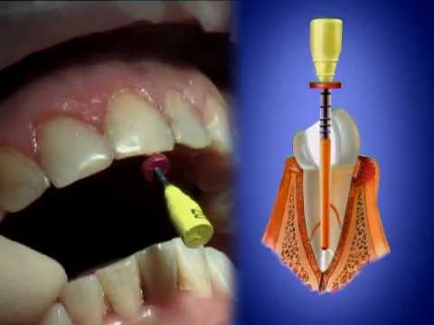 Гуттаперчевое трехмерное пломбирование зубов.
