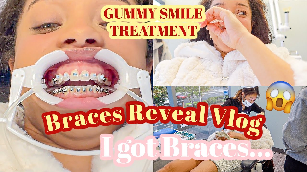 I GOT BRACES! GUMMY SMILE BRACES PROCEDURE VLOG ♡