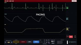 Transcutaneous Pacing Simulation — MegaCode Studio Patient Monitor screenshot 5