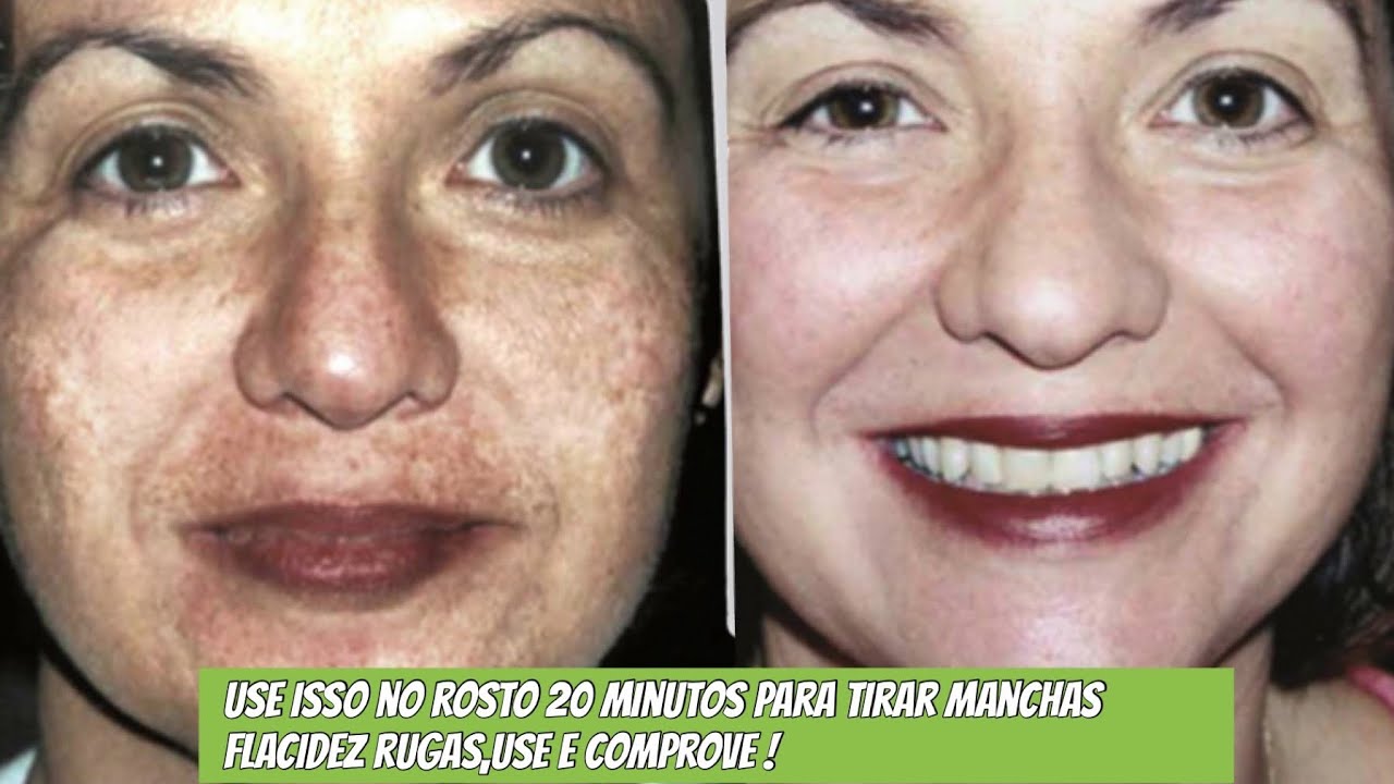 como tirar manchas de sol do rosto