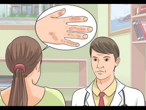 El tratamiento público la psoriasis asd