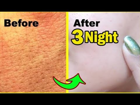 Apply it 3 Night SKIN Repair Overnight How to get rid of Large OPEN PORES permanently NATURALLY