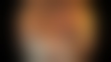 Colonoscopy: Ascending Colon EMR - SSA Enbloc Resection