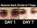 Top 5 Home Remedies To Remove Dark Circles Permanently In 7 Days - How To Remove Dark Circles