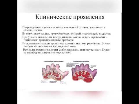 Синдром длительного сдавления