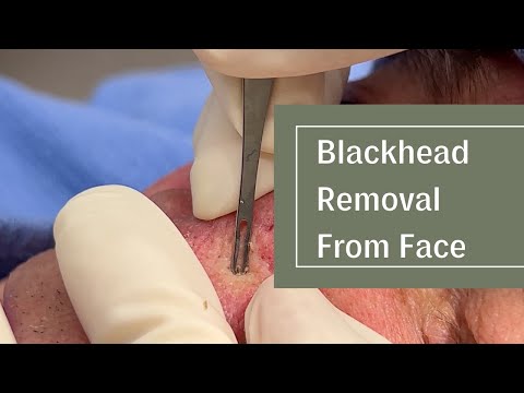 Blackhead Removal From Face! | Dr. Derm