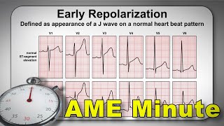 AME Minute: Identification of ECG Normal Variants Reduces Delays - Part 4