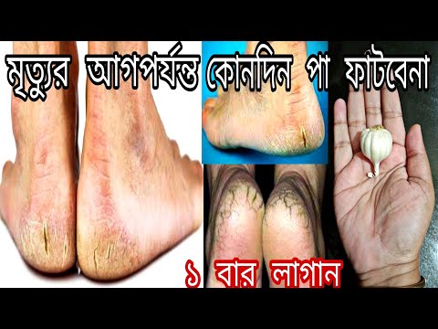 ভিডিও: গোড়ালি মোচ প্রতিরোধের ৫ টি সহজ উপায়