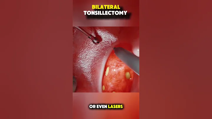 3D Animation: What Happens During Tonsil Surgery