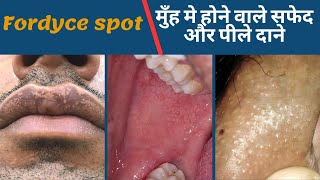 Fordyce spot | ओंठ मे होने वाले सफेद और पीले दाने | white spot on lip and mouth treatment/ Dr Uttam
