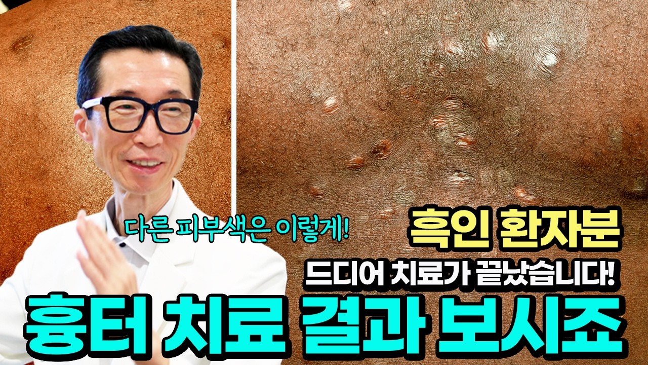 피부색이 완전히 달라도 치료가 될까? 한국까지 흉터 치료하러 온 흑인 환자의 감동적인 변화????