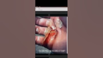 David Goggins Injury After Pull ups record ⚠️💪 #shorts #motivation #dailymotivation #dailyshorts