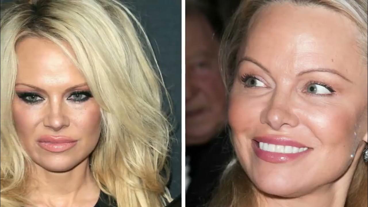 Памела андерсон до и после операции 1+2=3 маммопластика селебрити