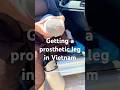 Amputee Getting A Prosthetic Leg In Vietnam Amputee Amputeetravel 