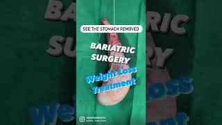 Weight Loss Operation In Surat Bariatric Surgery In India