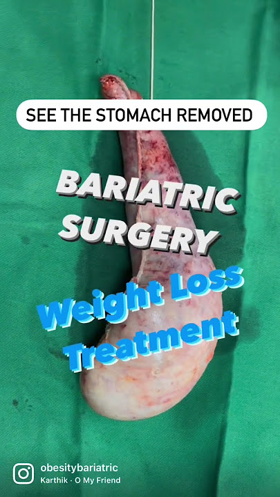 Weight Loss Operation in Surat - Bariatric Surgery In India