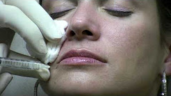 Juvederm Ultra Injection to NasoLabial Folds (laugh lines) by Reston Virginia Cosmetic Surgeon