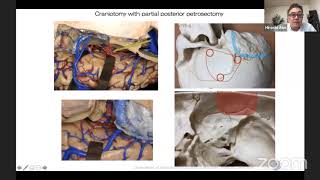 Subtemporal Approach for STA-SCA and STA-PCA Bypass- Hiroshi Abe