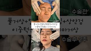 안면거상술 후 피부 탄력도 변화 #안면거상후기 #안면거상술후기 #안면거상